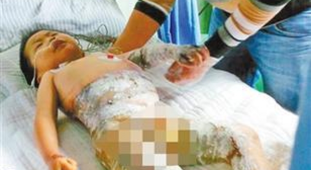 4岁娃意外掉进滚烫豆浆锅内:妈妈,好痛!