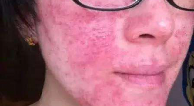 激素脸脱皮怎么治疗 裸脸多久角质层能恢复