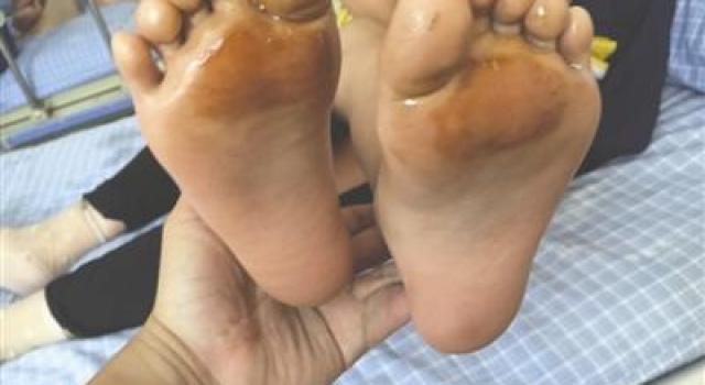 太狠!川小学生37度高温被罚光脚跑步 红肿溃烂惹人怜