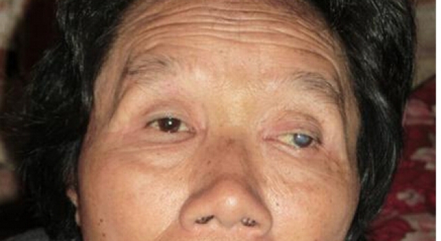 挨揍竟然能保健？女子听信后被打256次致右眼失明
