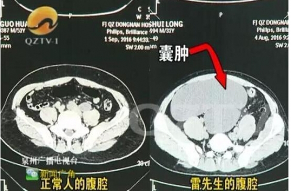 10万分之1的概率!男子肚子肿大像怀孕 体内竟藏4个肾