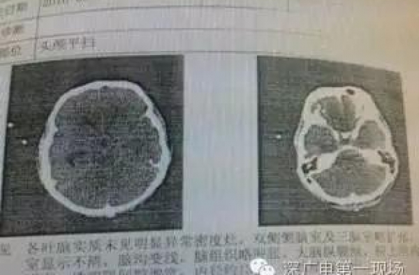 "吃脑虫"出没!男子大脑被"吃脑虫"入侵 两周后离世