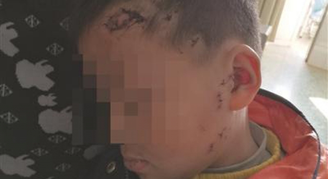 年初一6岁男孩被狗扑倒撕咬 嘴唇缝了20多针