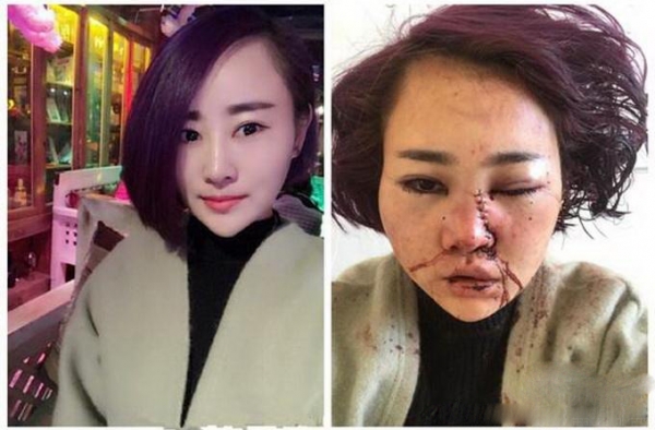 丽江被打毁容女孩公开近照：绝望中挣扎 事件全回顾