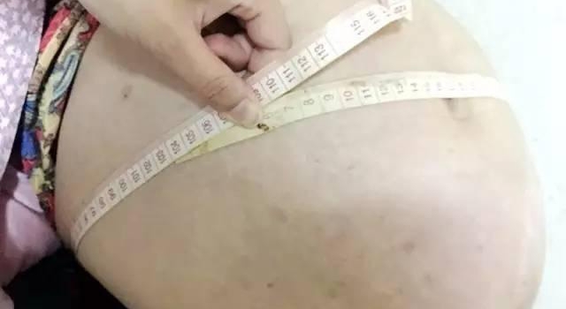 女子怀孕17年怎么回事？腹中竟然取出一团头发和牙齿