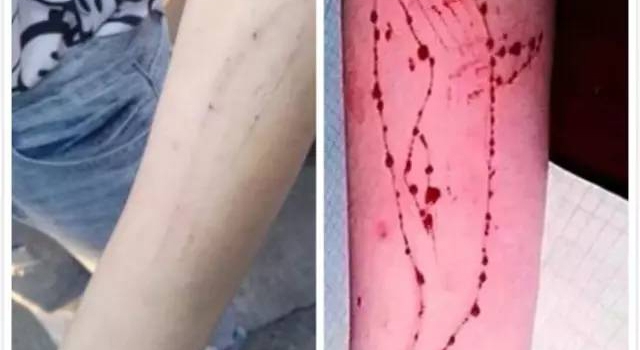 少女手有刀疤被疑玩蓝鲸死亡游戏 背后的真相让人心酸