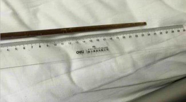男子与人打赌吞16厘米筷子 30年后在医院取出筷子