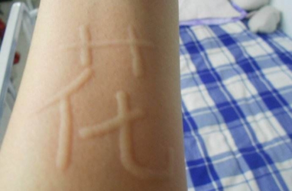 女友被男友吻过敏全身起红斑 难道是男友的口水有毒？