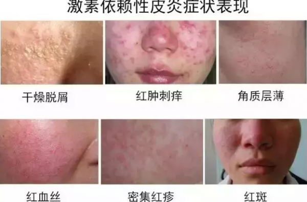 脸反复过敏是激素脸吗 激素脸和过敏脸如何区分