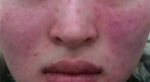 激素脸用什么可以恢复？脸部激素性皮炎怎么治