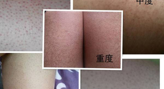腿上鸡皮肤怎么消除 有效去鸡皮肤最全攻略