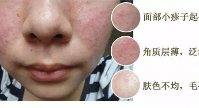 激素脸反跳严重怎么办?激素脸修复过程反跳症状很严重
