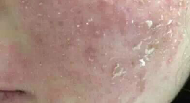 激素脸干燥脱皮如何改善？激素脸开始脱皮是怎么回事是在换皮吗