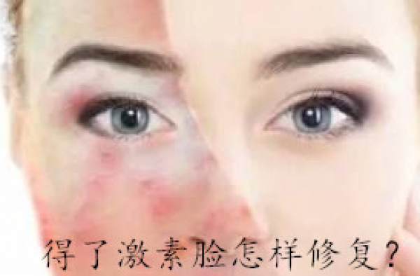 得了激素脸怎样修复？那么激素脸要怎么才能好