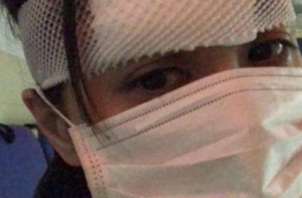 阿Sa透露阿娇伤势，已拆线但留下伤疤，坦言被血流满面样子吓到