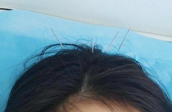 杨幂太忙累出病？扎针灸不忘晒照调侃，赵丽颖同样中药杯不离手