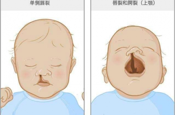 同样是＂兔唇＂，为什么李嫣就能＂笑得出来＂？王菲功劳很大